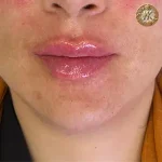تزریق ژل و فیلر، کلینیک زیبایی مهدخت