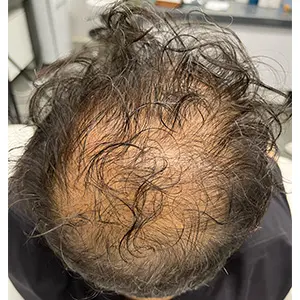 مزوتراپی مو   قبل