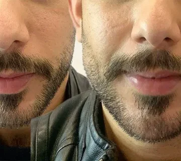 تحديد الفك والذقن (تكساس)
