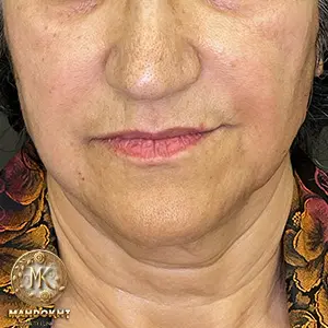 جوانسازی صورت   بعد