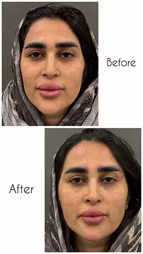 اصلاح زاویه فک