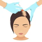 Hair filler هیرفیلر