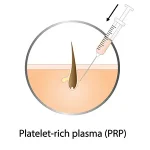 PRP تزریقی