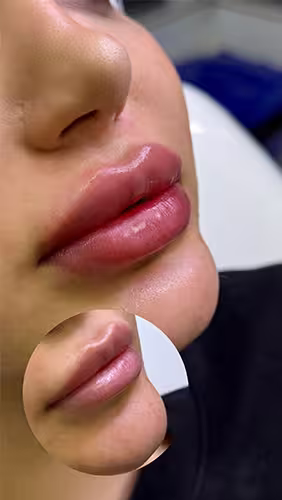 فیلر لب روسی