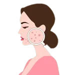 سابسیژن Subcision