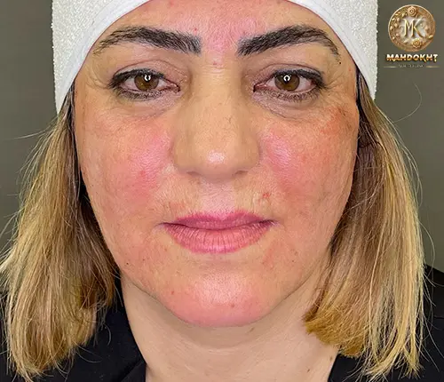 لیفت با نخ   بعد