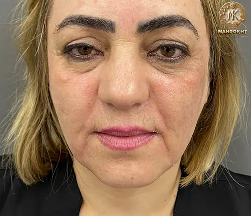 لیفت با نخ   قبل