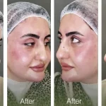 علاج الهالات السوداء وتجويف تحت العين