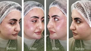 علاج الهالات السوداء وتجويف تحت العين