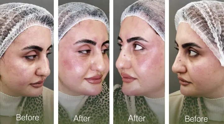 علاج الهالات السوداء وتجويف تحت العين