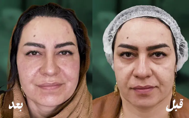 علاج الهالات السوداء وتجويف تحت العين