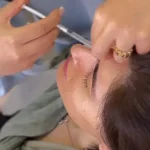 رفع خط اخم با بوتاکس