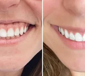 اصلاح لبخند لثه ای با بوتاکس