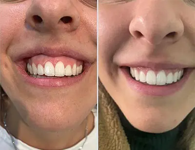 تزریق بوتاکس لبخند لثه ای