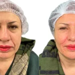 تزریق فیلر