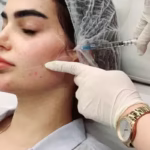 فیلر گونه شیراز