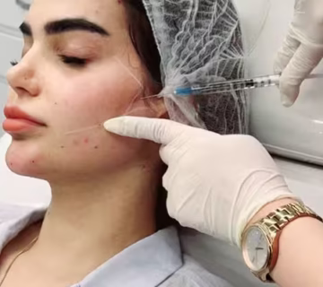 فیلر گونه شیراز