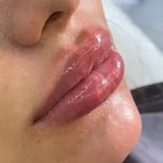 تزریق ژل و فیلر