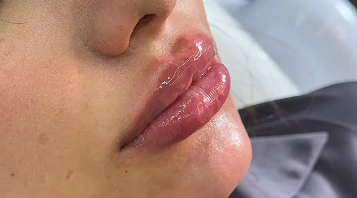 تزریق ژل و فیلر