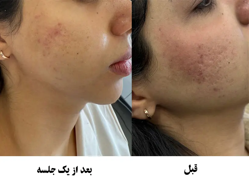 سابسیژن