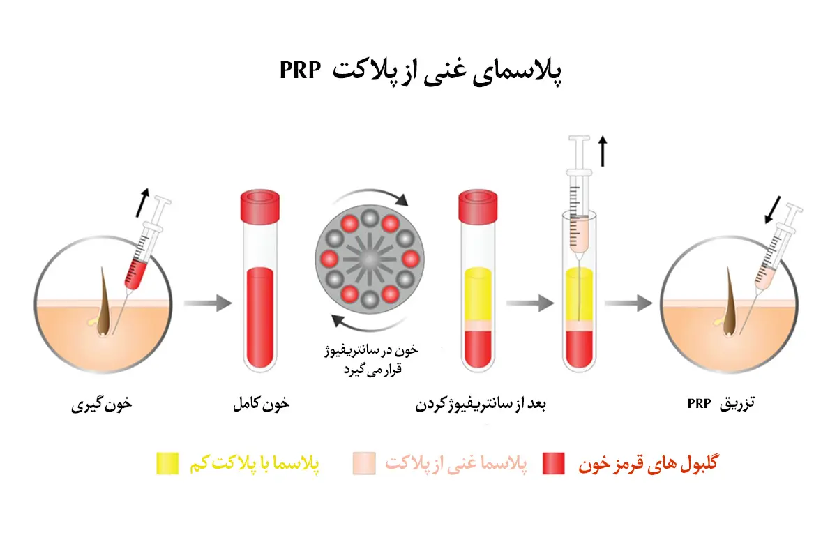مراحل استخراج PRP