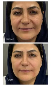 تزریق دیمونو
