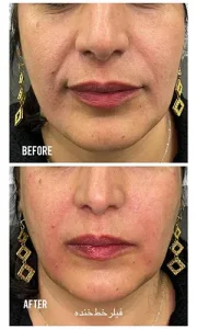 تزریق ژل خط خنده