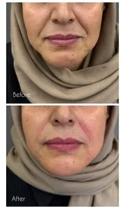 تزریق ژل خط خنده