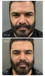 تزریق ژل خط خنده