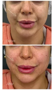 تزریق ژل خط خنده