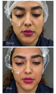 تزریق ژل خط خنده